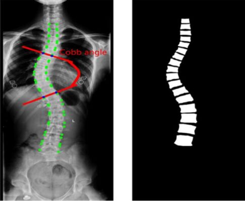 Understanding Cobb Angle Scoliosis Assessment - forethoughtmed