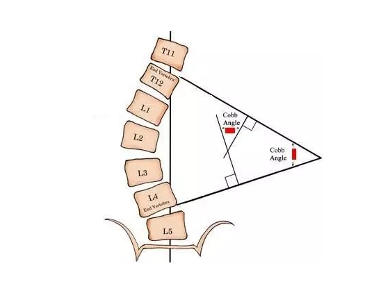 Cobb Method of Measuring Scoliosis and Forethought's Handheld Screening ...