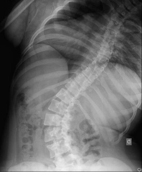 Resources and Insights for Understanding Scoliosis