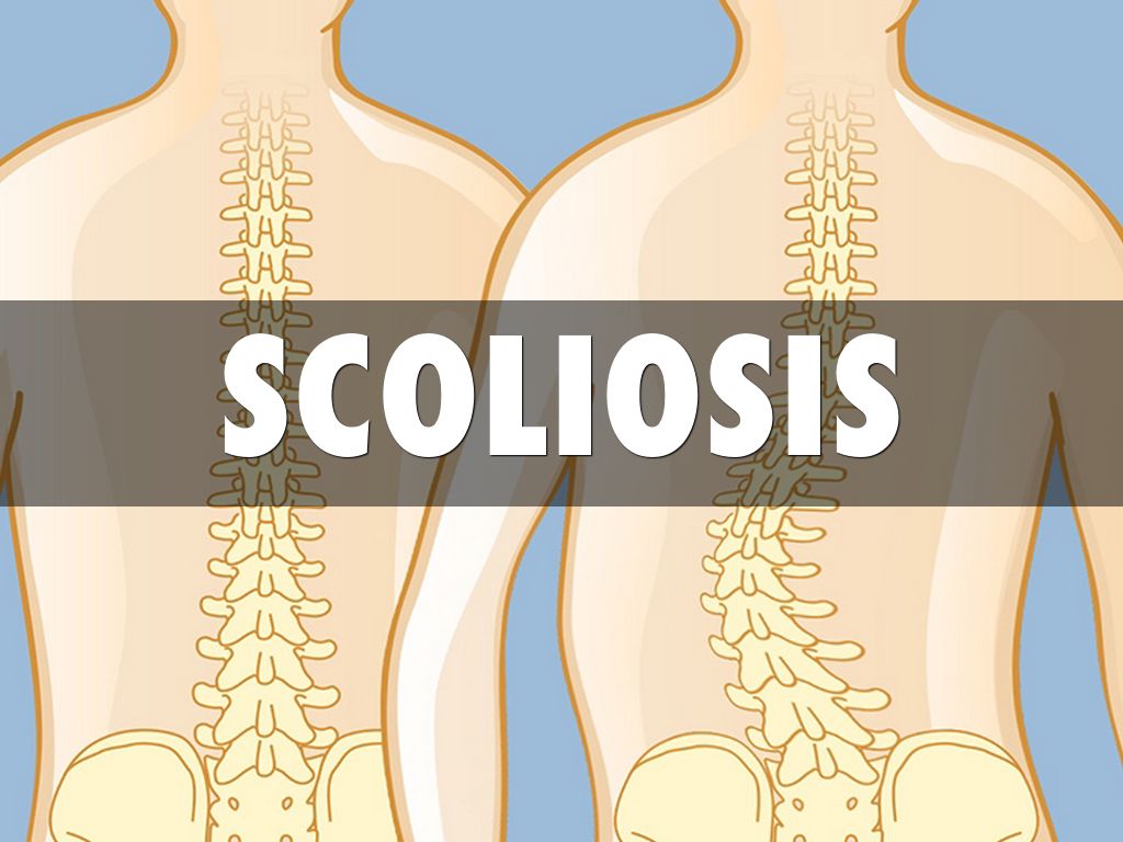 Halo for Scoliosis: Pros and Cons of Using Halo Traction in Scoliosis ...