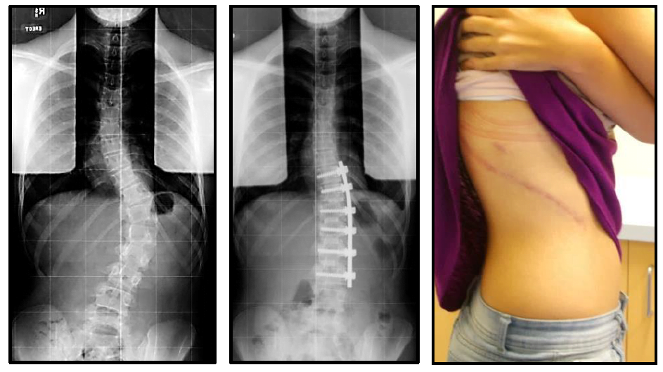 Scoliosis Halo Treatment: Understanding the Use of Halo Devices in ...