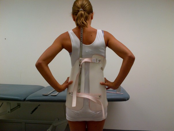 Scoliosis Treatment Without Surgery Exploring Non Surgical Approaches