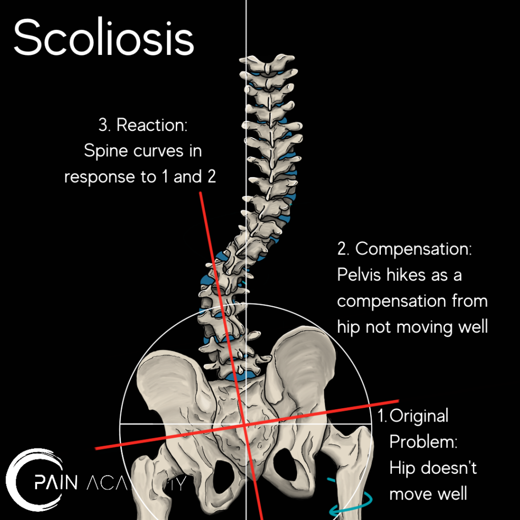 Scoliosis Hip Dysplasia: How Scoliosis Can Affect Hip Development and ...