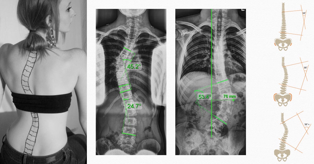 Thoraco Lumbar Scoliosis: Causes, Symptoms, and Treatment Methods ...