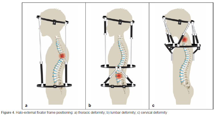 Scoliosis Halo Treatment: Understanding the Use of Halo Devices in ...