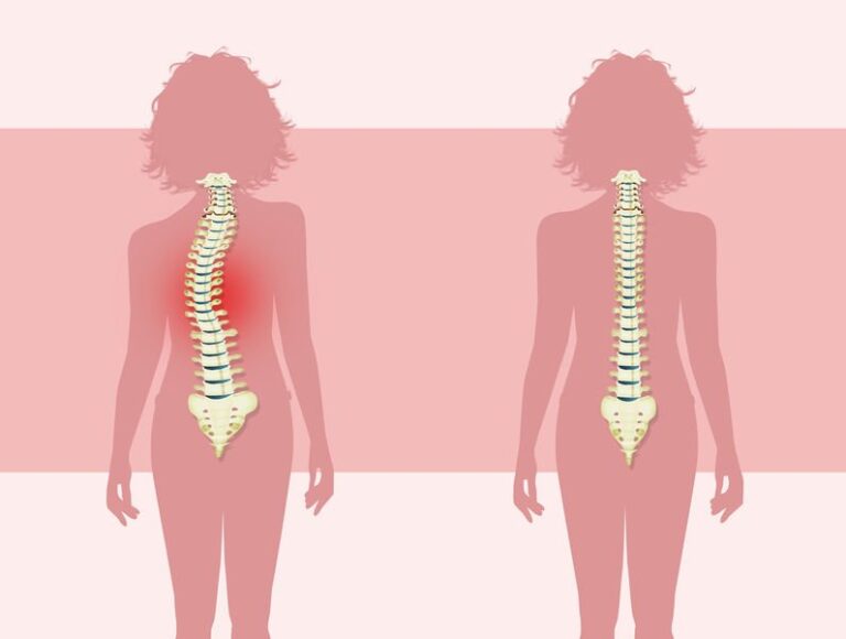 The Risser Sign and Scoliosis: Understanding Its Role in Assessing ...