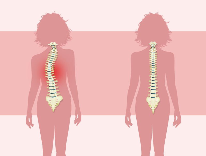 Scoliosis Weight Lifting: A Detailed Guide to Safe and Effective ...