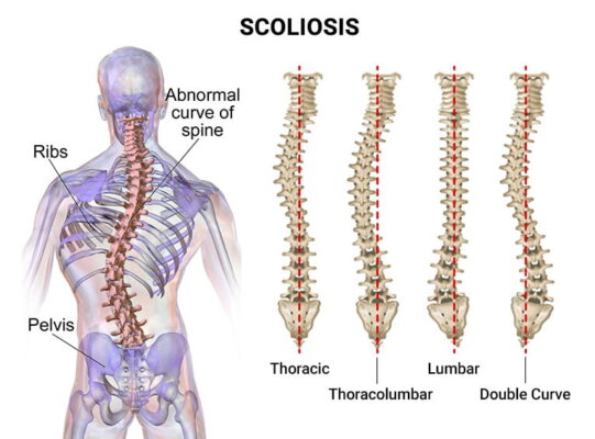 Understanding Scoliosis Anatomy: Key Structural Changes and Their ...