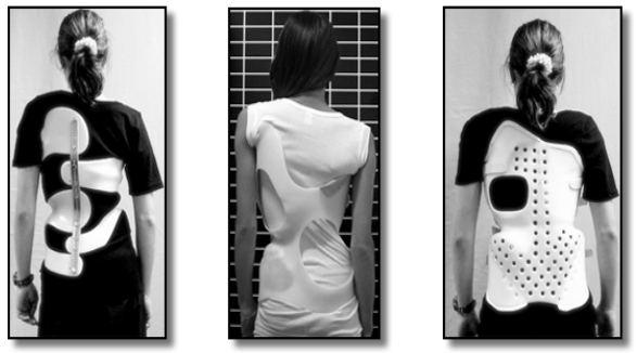 Old-Fashioned Scoliosis Brace: A Look at Traditional Scoliosis Braces ...