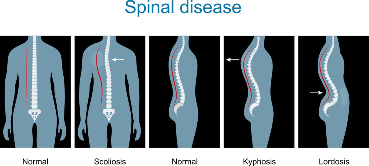 Lordose vs Cifose vs Escoliose: Comparação dos diferentes tipos de ...