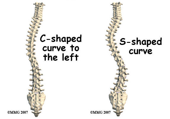 Dextroscoliosis vs Scoliosis: Understanding the Differences and ...