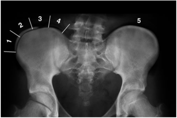 Understanding the Risser Scale Scoliosis: Assessing Spinal Growth and ...