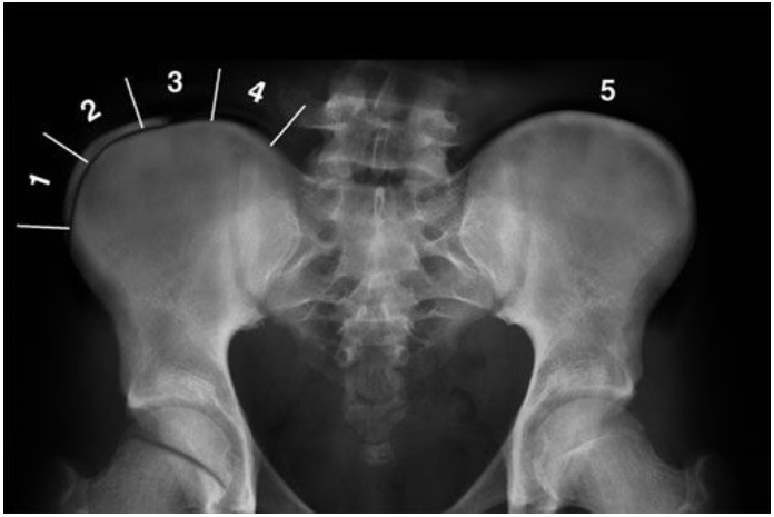 the Risser Scale for Scoliosis: Assessing Spinal Growth, Maturity, and Risk of Curve Progression