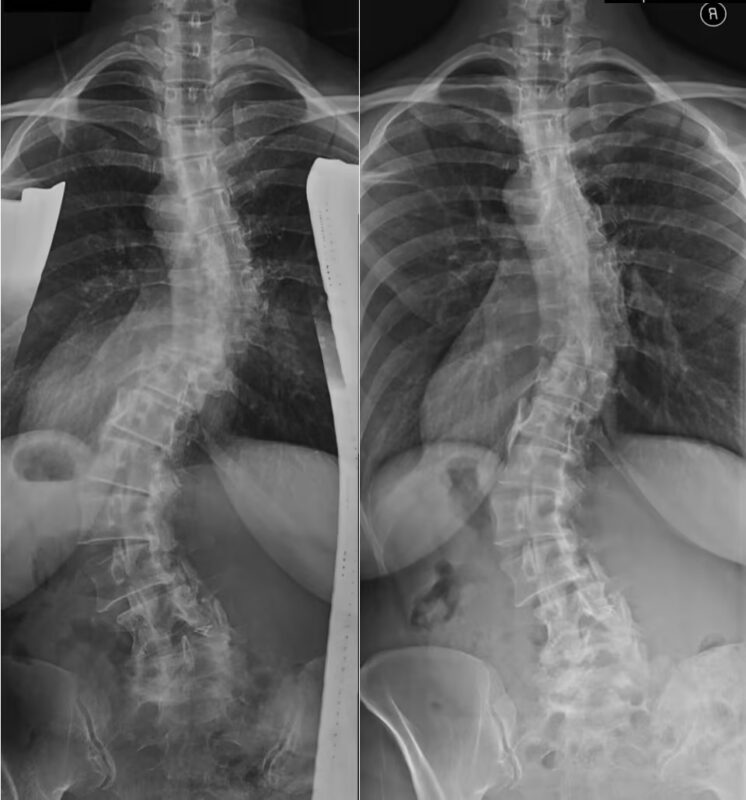 Scoliosis Series: An In-Depth Look at a Series of Articles or Resources ...