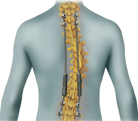 Dextrorotatory Scoliosis: Understanding Causes, Symptoms, and Treatment ...