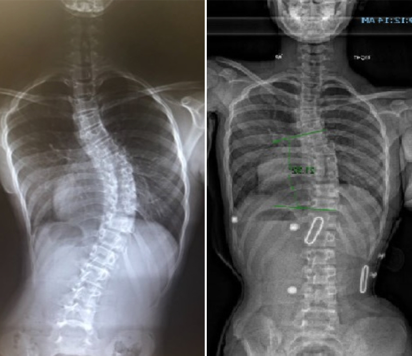 Severe Scoliosis XRay: Interpreting X-Ray Imaging Results for Severe ...