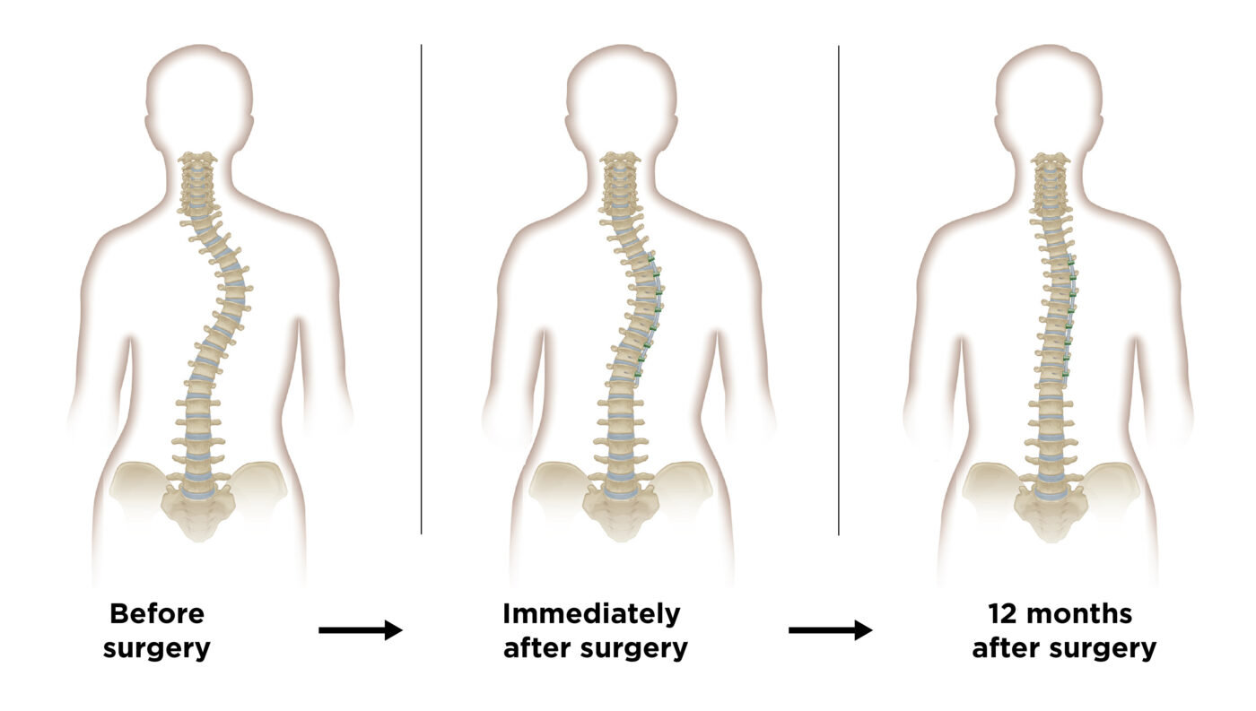 Scoliosis Degrees Severity: Understanding the Classification and Treatment