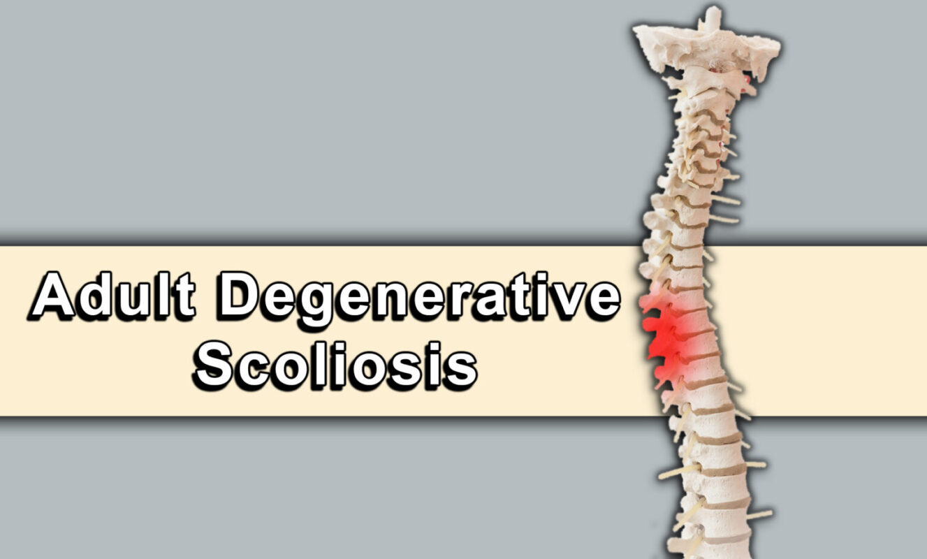 Understanding Degenerative Scoliosis
