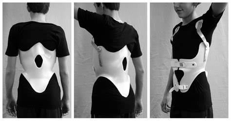 TLSO Scoliosis Brace: Choosing and Using a TLSO Brace for Optimal ...