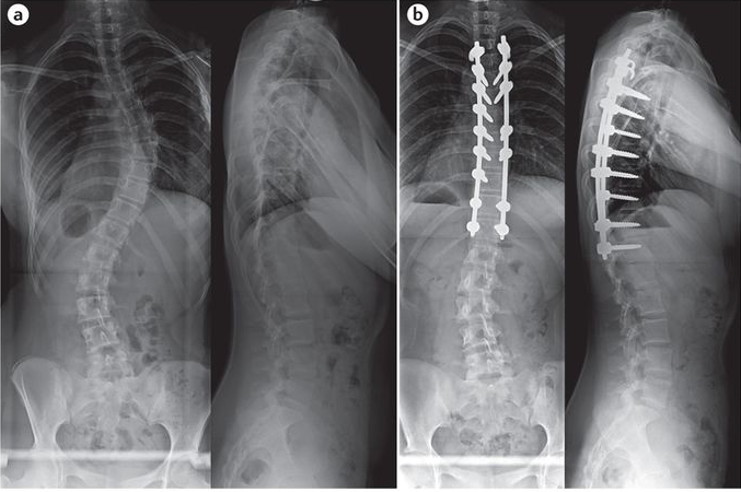 Moderate Scoliosis X-Ray: Interpreting X-Ray Results For Moderate ...