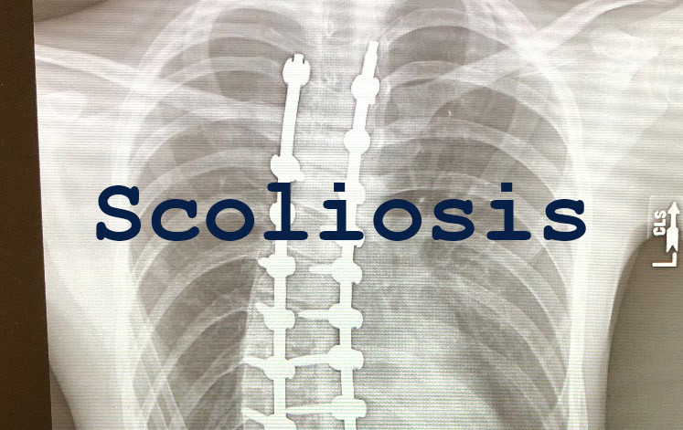 Complications of Scoliosis Surgery